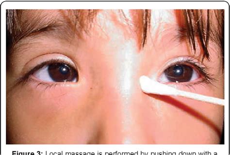 Figure 3 From Nasolacrimal Duct Obstruction Review Semantic Scholar