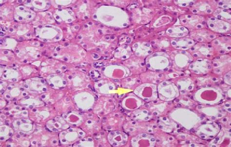 Marked Necrosis In Proximal Tubules With Hyaline Cast And Loss Of