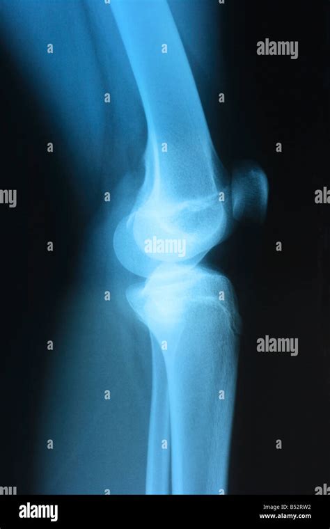 Radiografia Laterale Immagini E Fotografie Stock Ad Alta Risoluzione