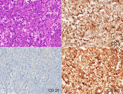 Photomicrographs Of The Biopsy A Large Atypical Cells Seen In Solid