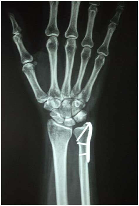 Ulnar Styloid Fracture Splint