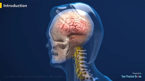 Chiari Decompression Surgery Video | Medical Video Library