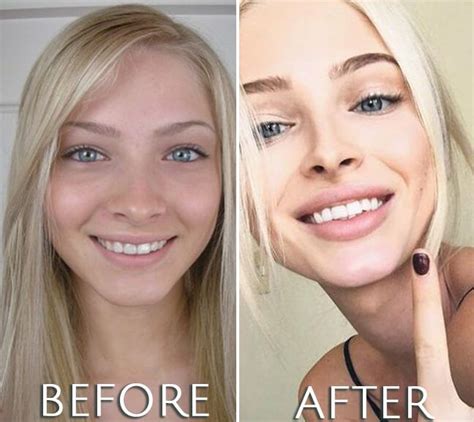 Alena Shishkova Before And After Plastic Surgery Plastic Surgery Lip