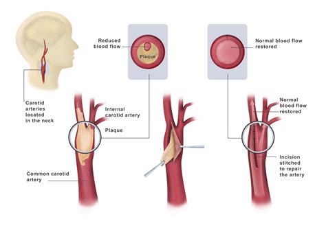 Carotid Endarterectom - Dubai - Dr. Ahmed Farah