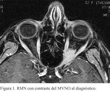 Arena Criticar Hueco Glioma Del Nervio Optico Por Favor No Lo Hagas