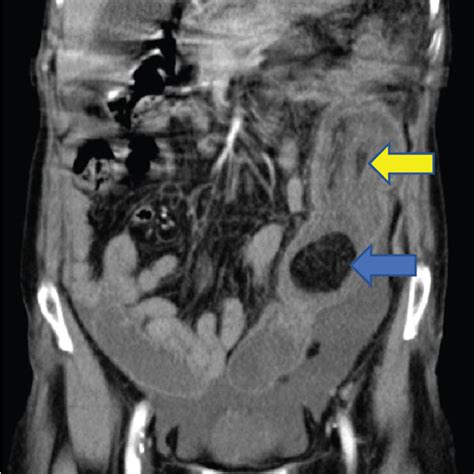 CT Scan Showing Intussusception Due To Colon Lipoma Contrasted Abdomen