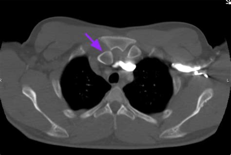 Posterior Sternoclavicular Dislocation Cta Annotated Jetem 2021 Jetem