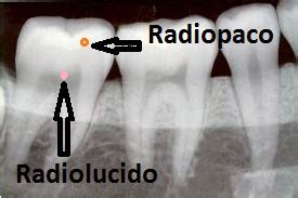 Radiopacidad Y Radiolucides Bases De Biofisica