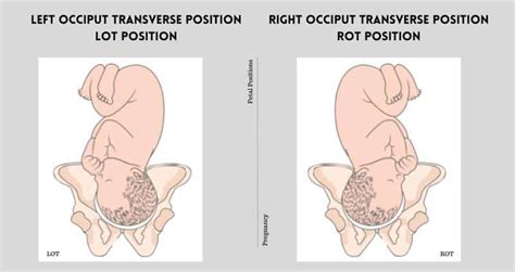 Left/Right Occiput Transverse Position: Impact on Labor & Delivery