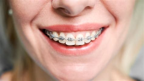 Exploring Types Of Braces Pros And Cons Cruzorthodontics