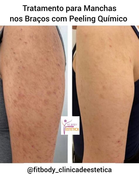 Tratamento Para Manchas Nos Bra Os Peeling Qu Mico Cl Nica Fit