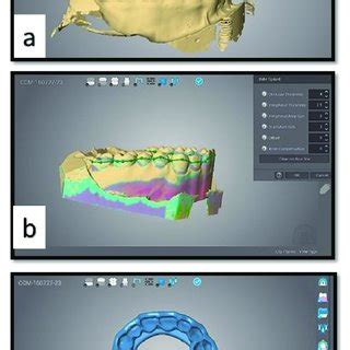 computer-aided designing of the splint. (a) The contour of the splint ...