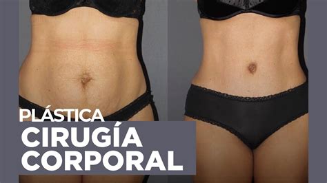 Liposucci N O Abdominoplastia Estas Son Las Diferencias Youtube