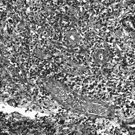 A Photomicrograph Of Renal Biopsy Showing Marked Interstitial Download Scientific Diagram