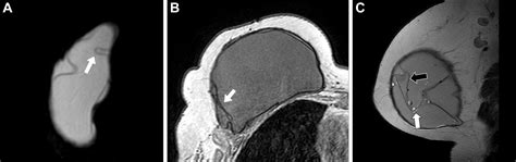 Mri For Evaluation Of Complications Of Breast Augmentation Radiographics