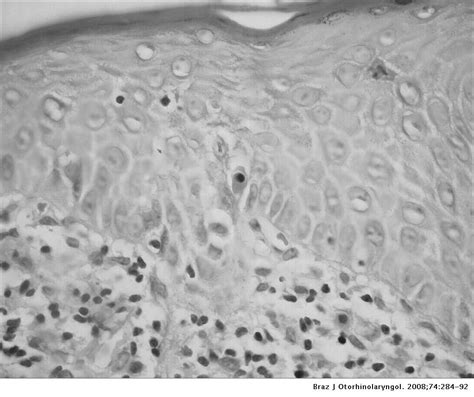 Oral Lichen Planus Clinical And Histopathological Considerations