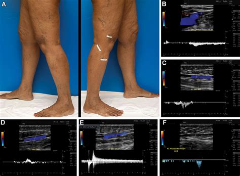 Varicose Veins Of The Lower Extremity Doppler Us Evaluation Protocols