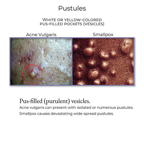 Clinical Pathology Glossary Pustule Ditki Medical Biological Sciences