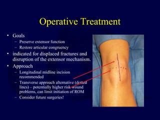 comprehensive overview  patella fractures anatomy diagnosis