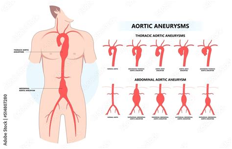 Anatomy Of Aortic Root Hot Sex Picture