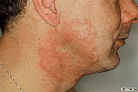 Tinea Of The Face Caused By Trichophyton Rubrum