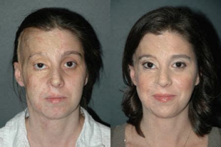 Their Deformed Faces Are Beautiful Again, All Thanks To Cosmetic Technology - Gallery | eBaum's ...