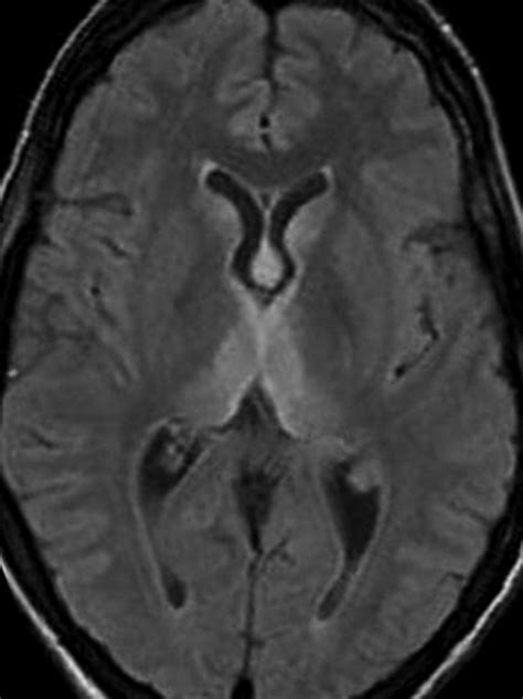 Bilateral Thalamic Lesions AJR