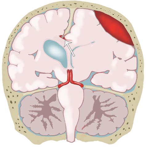 Types Of Cerebral Herniation And Their Imaging Features Radiographics