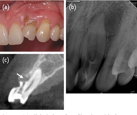 Figure From Endodontic Management Of A Maxillary Lateral Incisor With