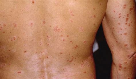 What Is Guttate Psoriasis Causes And Best Treatment Options Easy