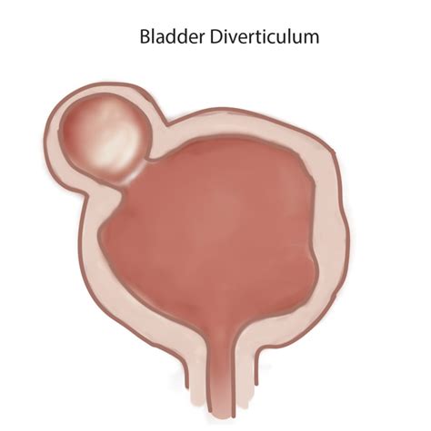 Bladder Diverticulum Statpearls Ncbi Bookshelf