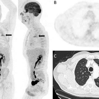 A Mip B Axial F Fdg Pet And C Axial Ct Weeks After