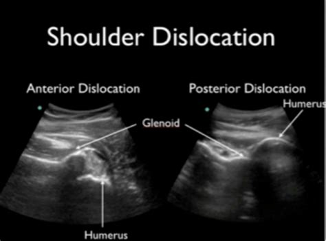 Luxatio Erecta Ultrasonography And Reduction County Em