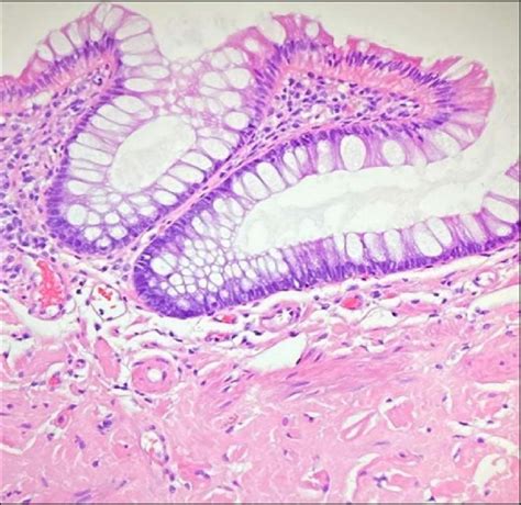 Rectal Mucosal Biopsy With Hematoxylin And Eosin Staining Demonstrating