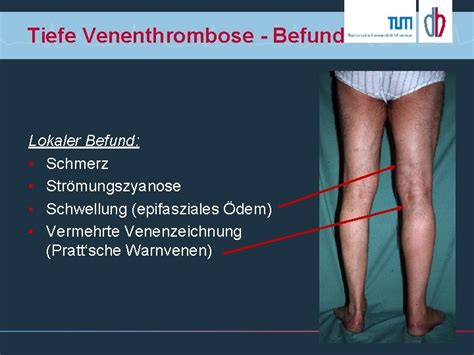 Thrombose Diagnostik Und Therapie Hintergrund Tiefe Venen Thrombose