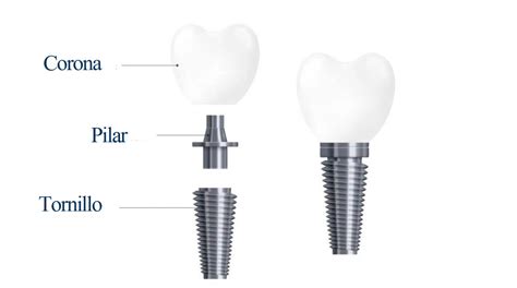 Guía de implantes dentales con caso clínico Dentaltix