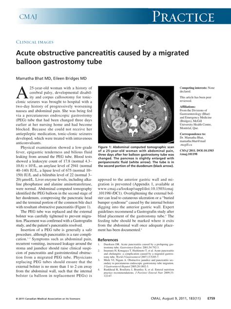 PDF Acute Obstructive Pancreatitis Caused By A Migrated Balloon