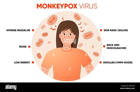 Les Sympt Mes Du Virus De La Variole Infographie Simple Affiche Pour