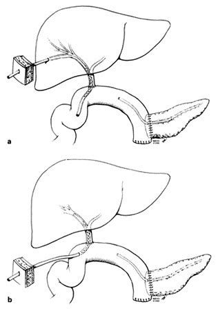 Biliary Decompression A Transhepatic Tube B Retrograde Transjejunal