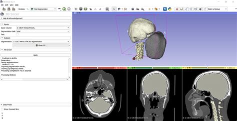 New Extension Fully Automatic Whole Body Ct Segmentation In 2 Minutes Using Totalsegmentator