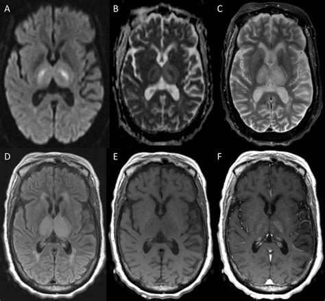 One Week Follow Up Magnetic Resonance Imaging Mri Of The Brain For