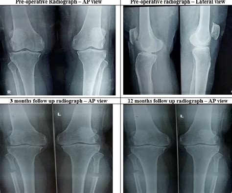 Figure 1 From How Does Medial Compartment Osteoarthritis Of Knees