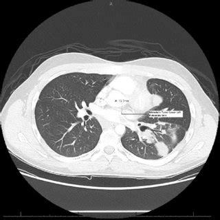 Preoperative Computed Tomography Scan Showing The Lower Left Pulmonary