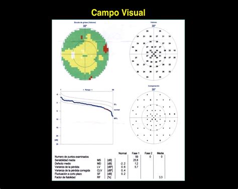 Campo Visual Somos Retina Y Mácula Consultores