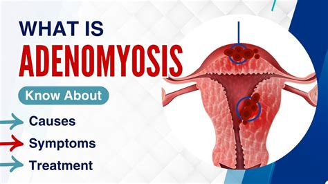 What Is Adenomyosis What Are The Symptoms Treatment And Diagnosis