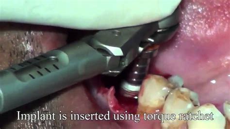 Surgical Implant Placement For Mandibular First Molar Youtube