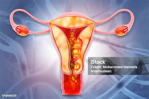 Female Reproductive System Diseases Uterus Cancer And Endometrial