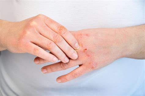 Gejala Scabies Yang Perlu Di Ketahui Batrisyia Herbal