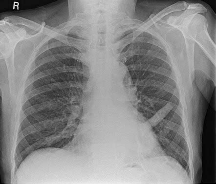 Xray Basics And CXR Flashcards Quizlet