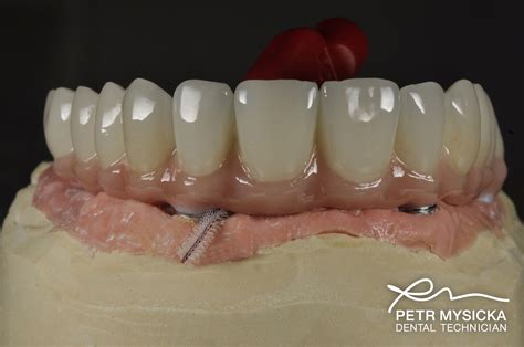 Zirconia All On 4 Bridge Brighton Implant Clinic Dental Implants